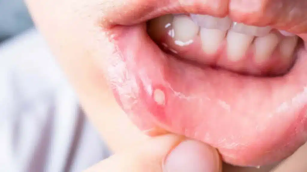 Mouth Ulcers