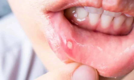 Mouth Ulcers